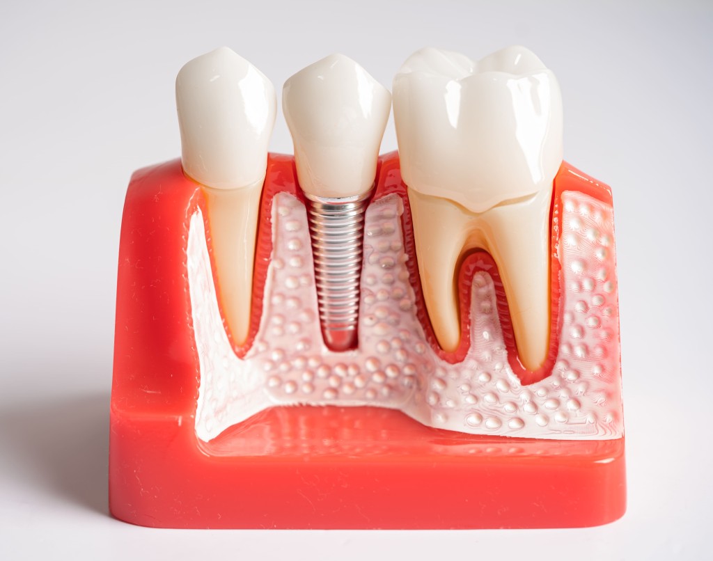https://app.envato.com/search/photos/fec4462e-4afd-4fc9-9027-d2583d8e02e7?itemType=photos&term=dental+implant