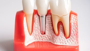 https://app.envato.com/search/photos/fec4462e-4afd-4fc9-9027-d2583d8e02e7?itemType=photos&term=dental+implant