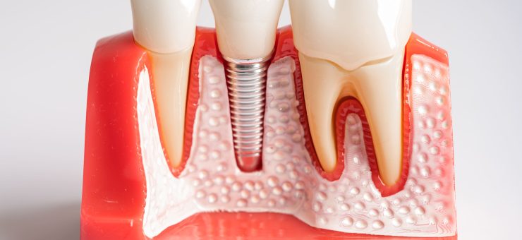 https://app.envato.com/search/photos/fec4462e-4afd-4fc9-9027-d2583d8e02e7?itemType=photos&term=dental+implant